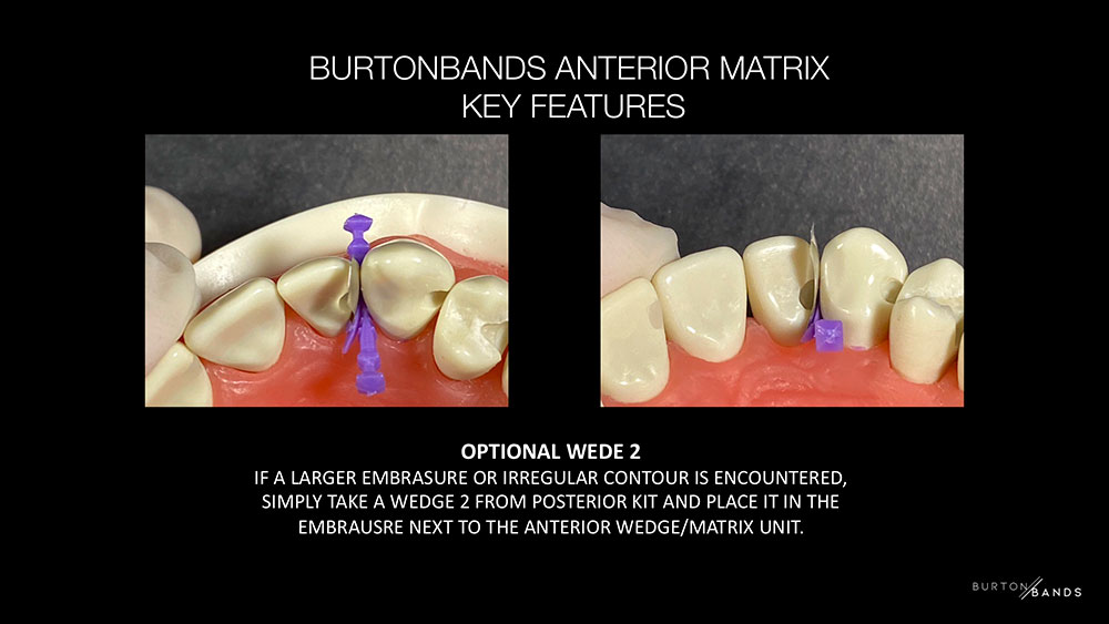 BurtonBands Anterior key features banner 2