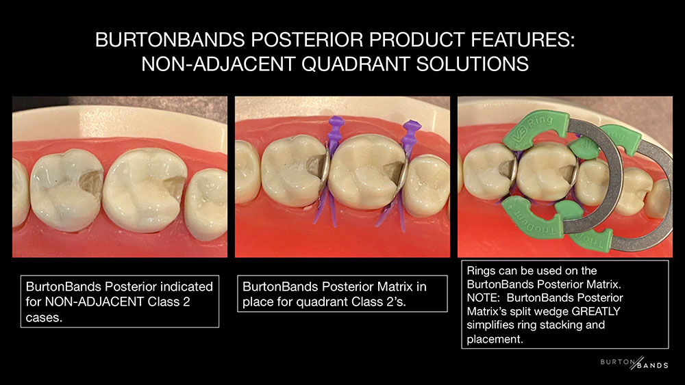 BurtonBands Posterior feature