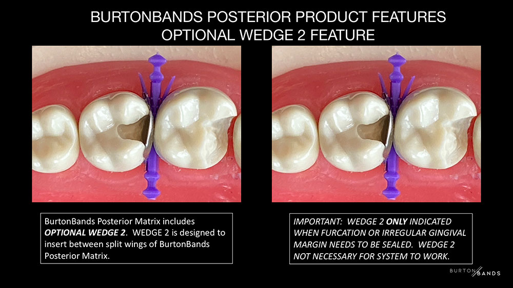 BurtonBands Posterior feature