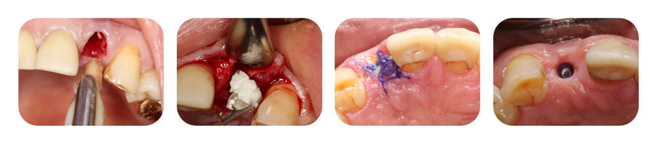 Allograft Clinical Cases