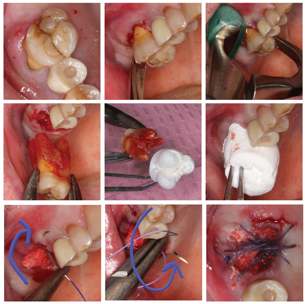 Clinical Case OsteoGen Plug image Set