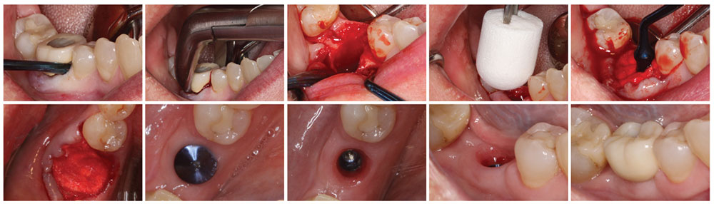 Clinical Case OsteoGen Plug image Set 2